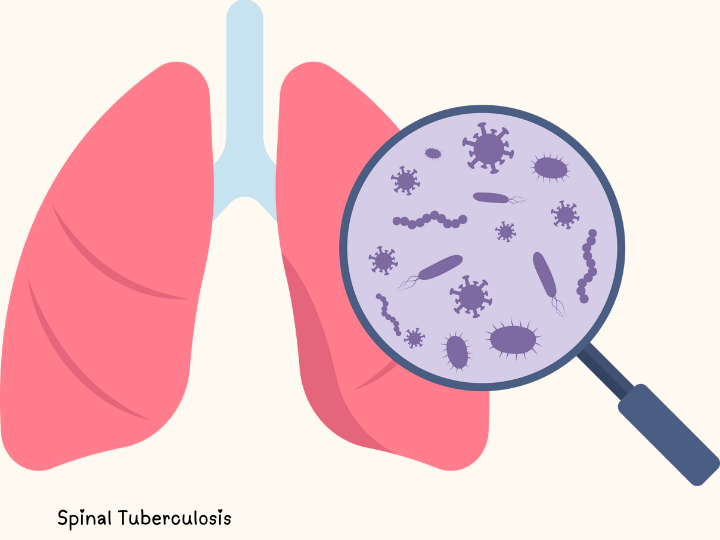 Spinal Tuberculosis Treatment Centers in Dadar